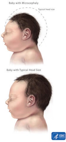 microcephaly-comparison-225px.jpg
