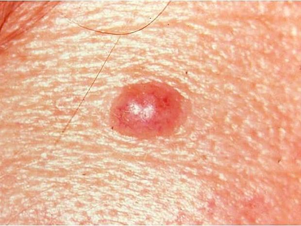 Identifying Moles Skin Cancer Or Mole How To Tell Pictures Cbs News