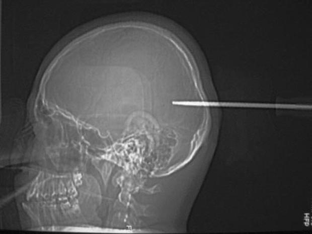 Swallowed Razor Blade Shocking Medical Scans Pictures Cbs News