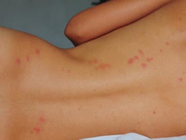 bedbugs_on_back.jpg