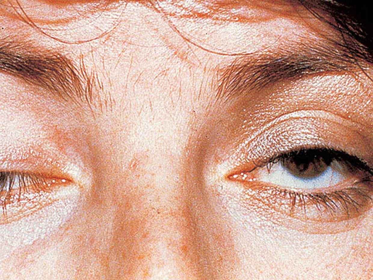 Marfan's Syndrome 12 scary things your eyes say about your health Pictures CBS News
