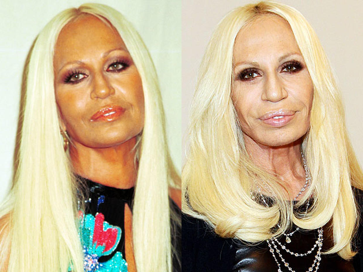 Celebrity Plastic Surgery Disasters Photo Cbs News