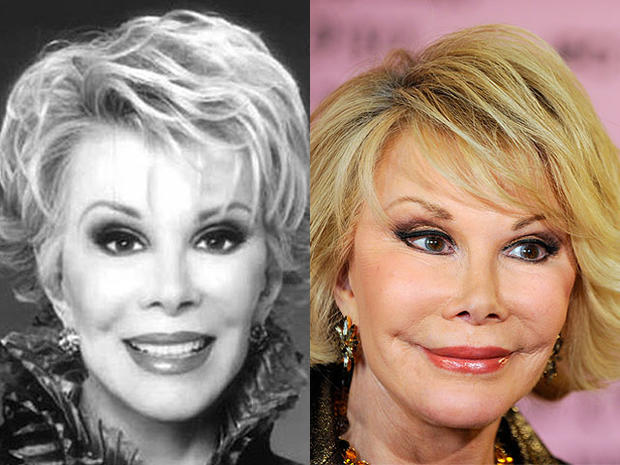 joan rivers before and after