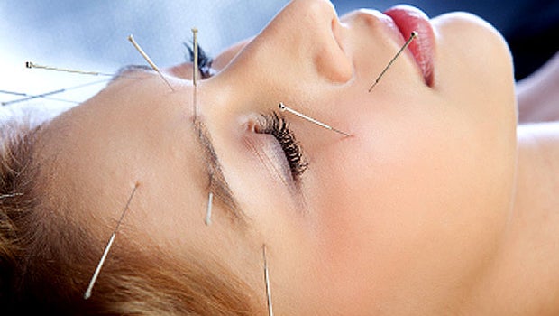 Acupuncture