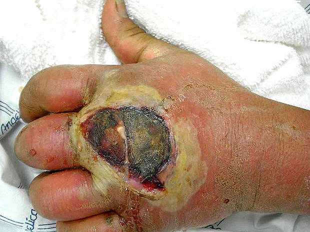 Mrsa pictures - MRSA STAPH INFECTION