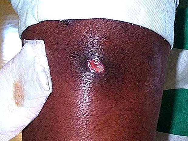 Pictures of Boils: Symptoms, Causes, Treatments, and More