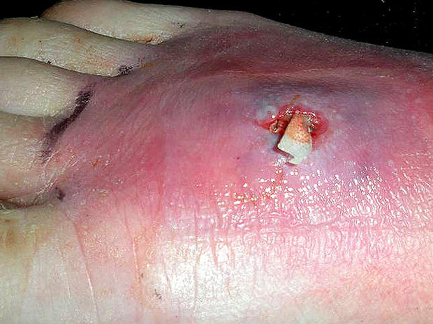 mrsa skin infections pictures #10