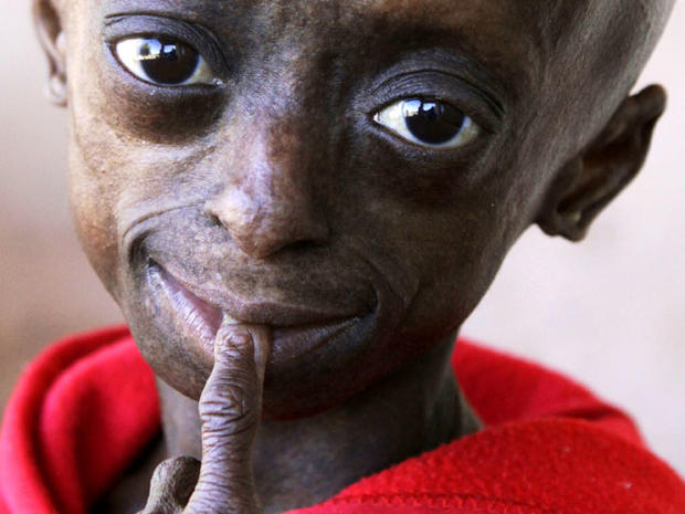 Progeria: First black child with rare aging disease ...