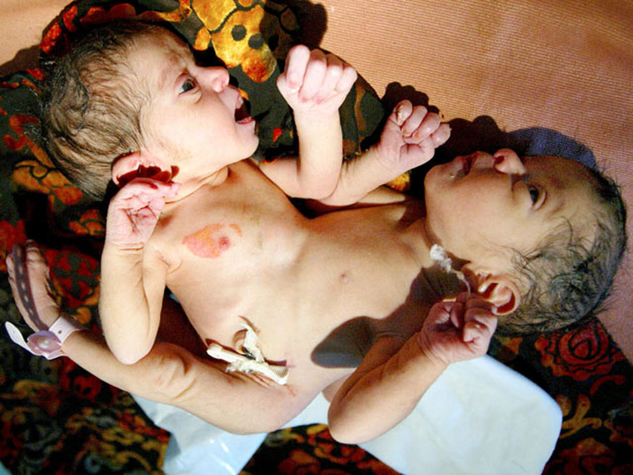 Conjoined Twins Amazing Photos Graphic Images Photo Pictures Cbs News