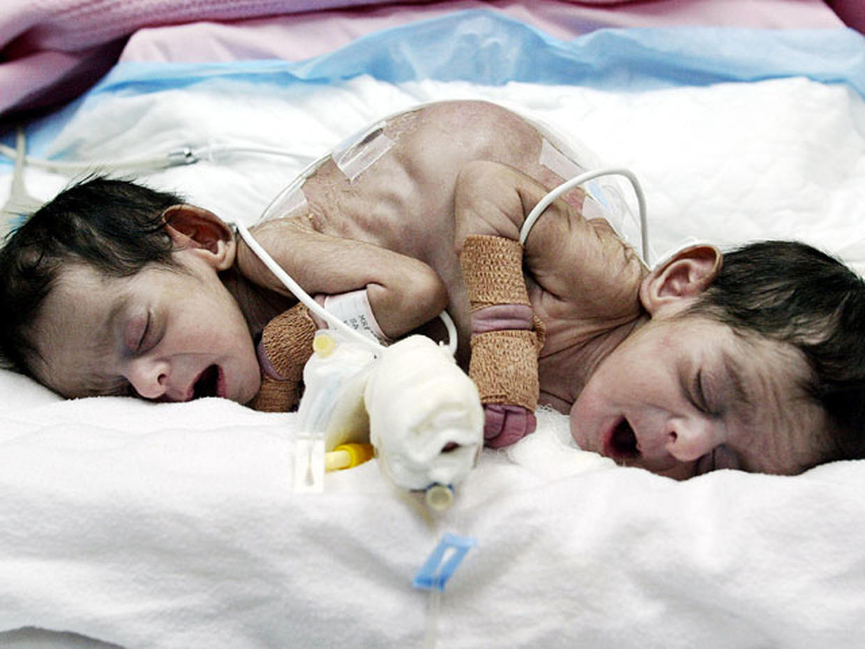 Conjoined Twins 40 Amazing Photos Graphic Images Photo 26 Pictures Cbs News