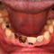 Meth Mouth Inside Look At Icky Problem Graphic Images Photo