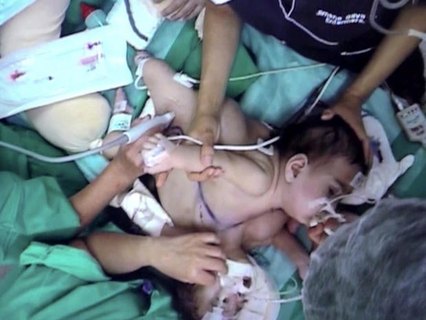 maria paz, maria jose, conjoined twins, chile