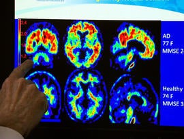 Experimental treatment for Alzheimer's prevention