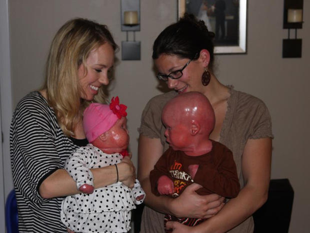 Meet Brenna, a baby with Harlequin Ichthyosis - Photo 2 ...