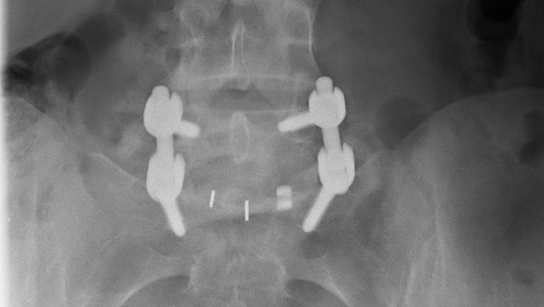 Device makers pay high-volume spine surgeons consulting, design fees - CBS News