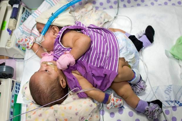conjoined-twins-5.jpg