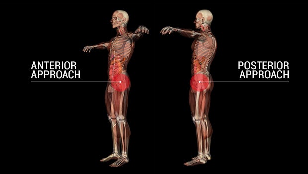 hip-replacement-splitv3.jpg