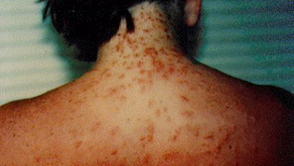 sea-lice-rash.png