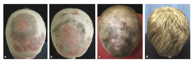 alopecia-hair-drug-jid-2014-0170-r1-figure-2.jpg 