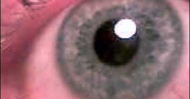 Eye Fungus Lawsuits Filed CBS News