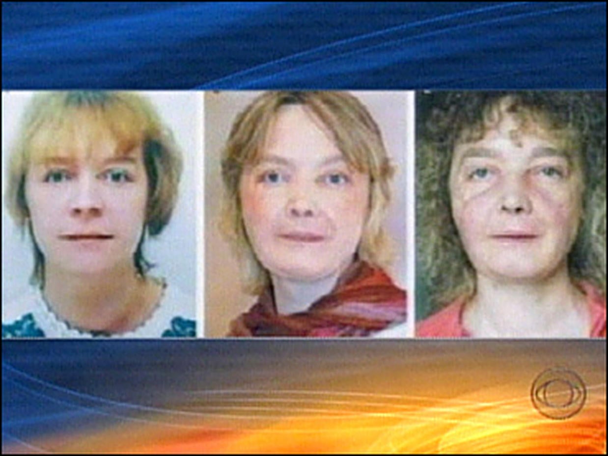 Face Transplant Amazing face transplants (GRAPHIC IMAGES) Pictures