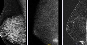 3D XRays Better Detect Breast Cancer Risk CBS News