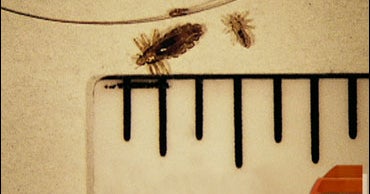 "Super" Lice, Simply Treated CBS News