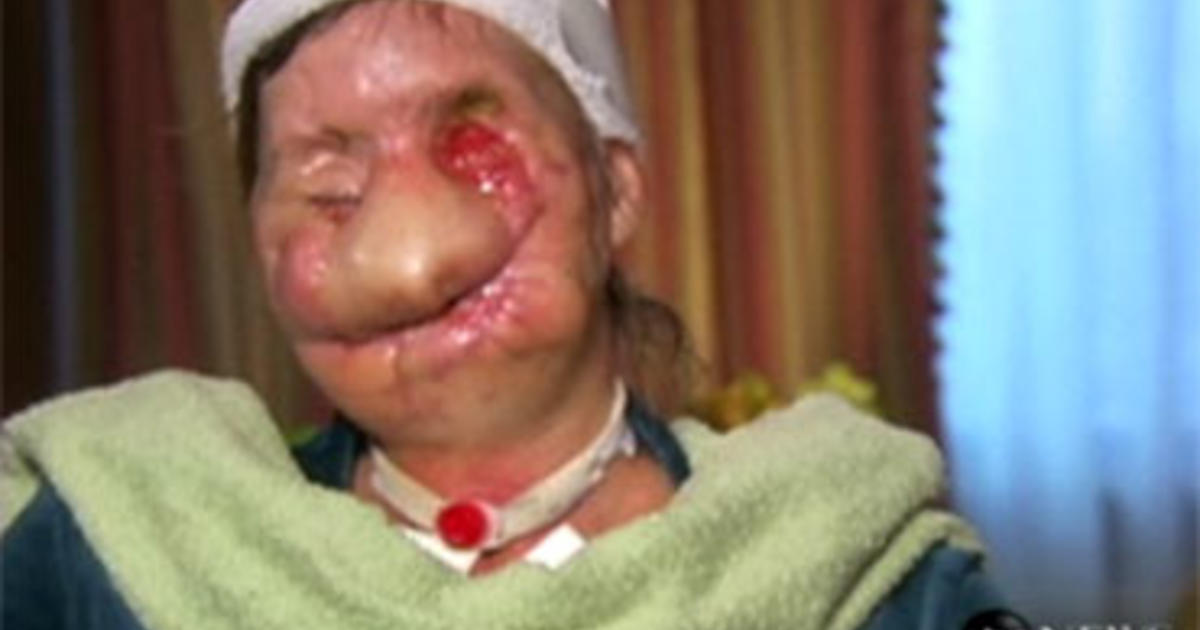 woman attacked by chimpanzee sues