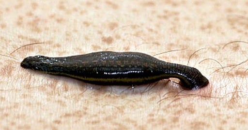 Leeches help doctors reattach woman's face CBS News