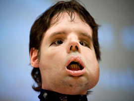Oscar, a man who underwent a full-face transplant in April, poses for the photographers as he appears in public for the first time in a news conference at the Vall d'Hebron Hospital in Barcelona, Spain.