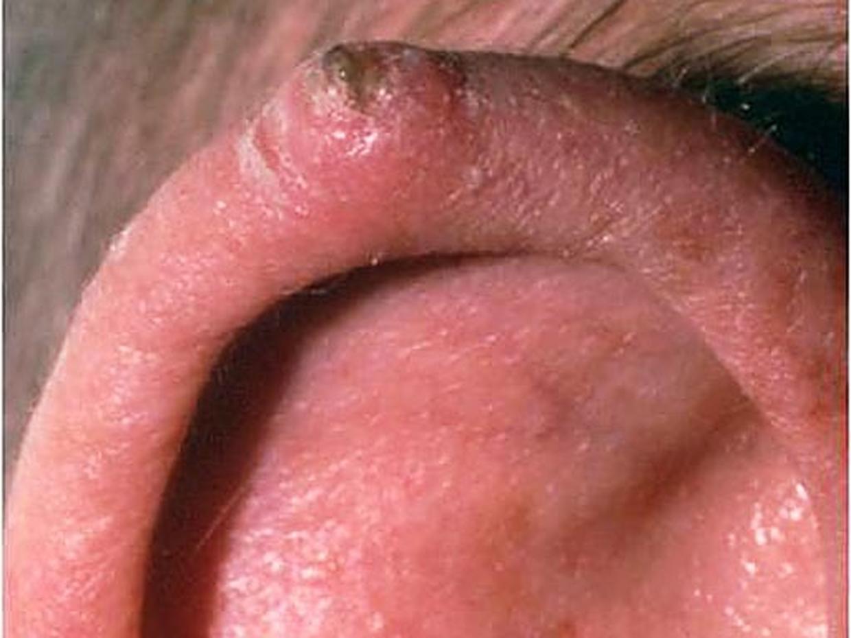 Skin Cancer Self Fefense Skin Cancer Or Mole How To Tell Pictures
