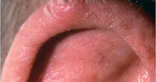 Basal Cell Carcinoma On The Ear Skin Cancer Or Mole How To Tell Cbs News the ear skin cancer or mole