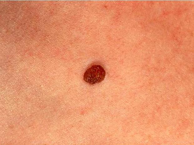 Moles Have Well Defined Borders Skin Cancer Or Mole How To Tell