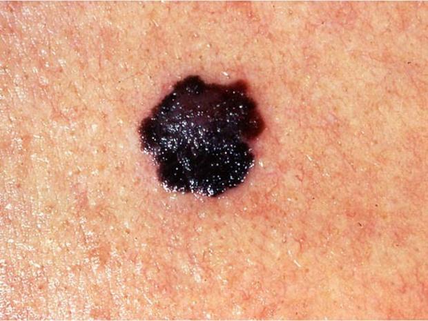 Skin Cancer Or Mole How To Tell Cbs News