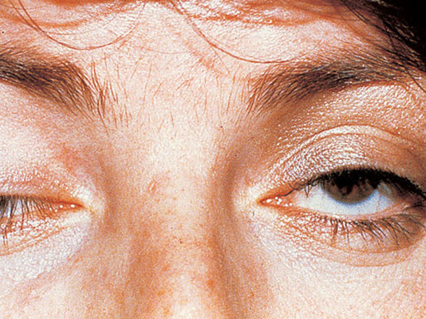 Ptosis-myasthenia-gravis.jpg 