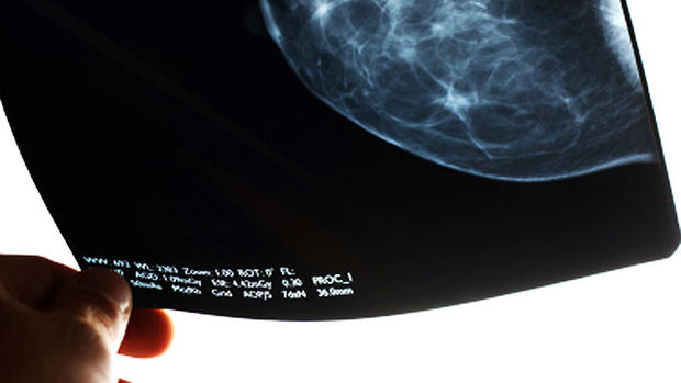 Busted! 8 mammogram truths every woman must know 