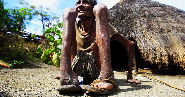 Neglected tropical diseases targeted by Gates Foundation, drug