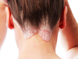 psoriasis, 4x3, istockphoto