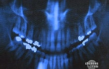 FDA Probes Cavity Fillings