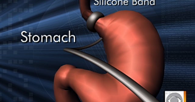 Lap band surgery availability widened CBS News