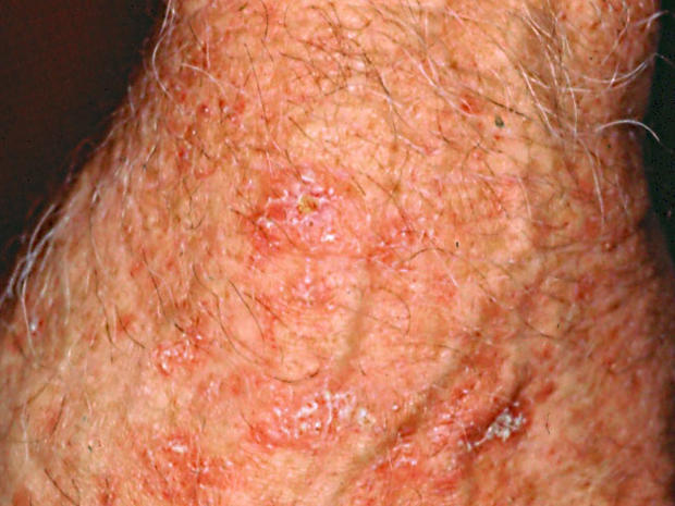 resize cell? a would why you Is  Pictures  it skin  cancer? cancer? News skin it   Is  CBS