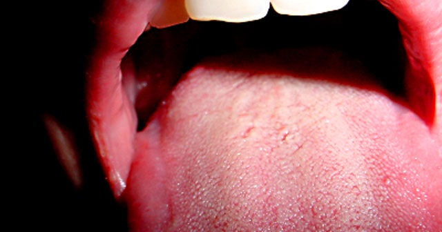 human papillomavirus on the tongue la copiii cu giardioză tiberală