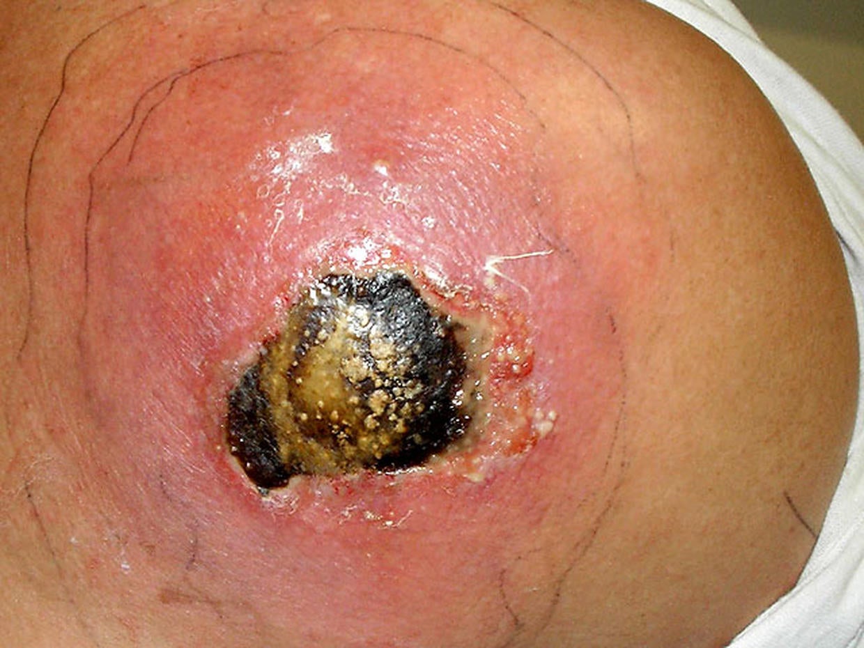 Deadly skin infection? 12 graphic photos that could save your life