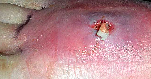 Deadly Skin Infection 12 Graphic Photos That Could Save Your Life Cbs News