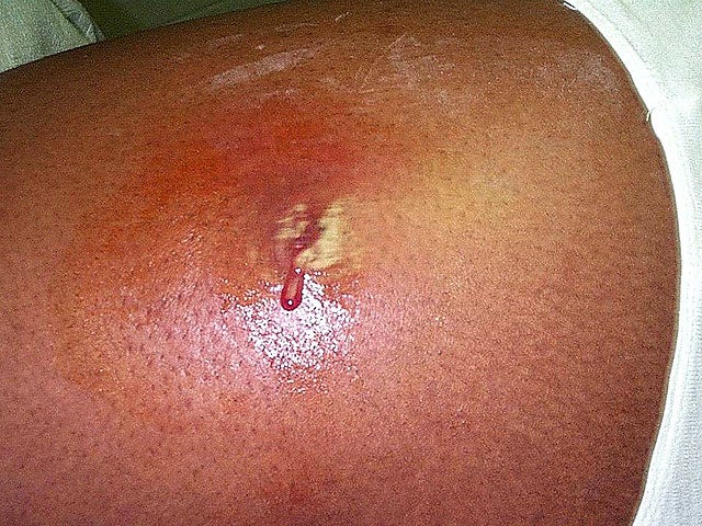 Deadly skin infection? 12 graphic photos that could save your life