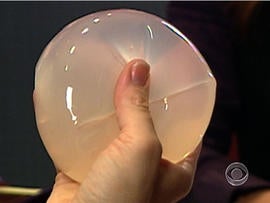 FDA: Breast implants don't last forever