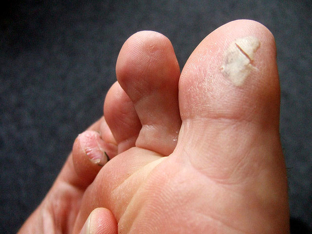 Ouch! 7 nasty foot flaws and how to fix them (GRAPHIC IMAGES) Photo 1