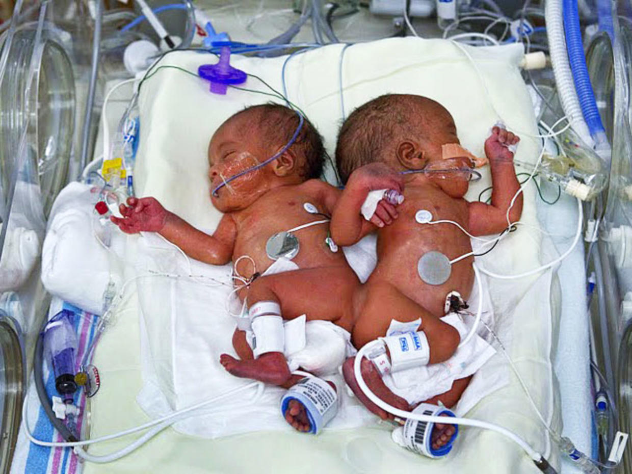 Medical Miracle Conjoined Twins Separated In Memphis Cbs News 