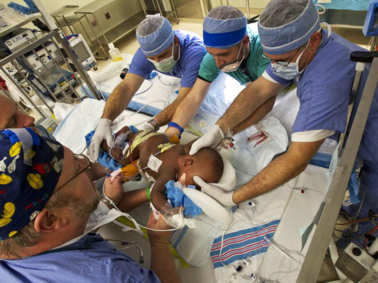 Medical Miracle Conjoined Twins Separated In Memphis Cbs News 