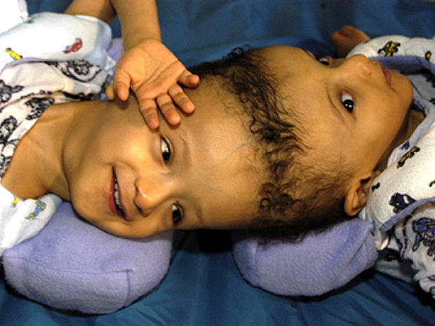 Conjoined Twins Warning Graphic Images Cbs News